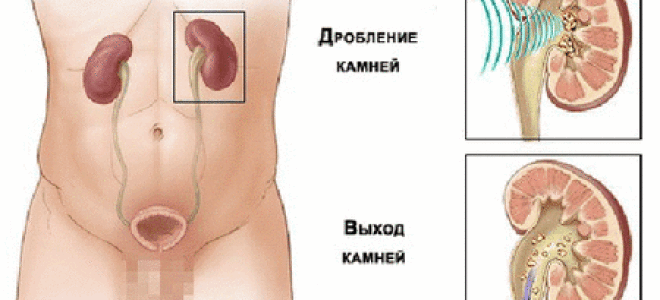 Удаление камней из почек: методы и прогнозы к выздоровлению