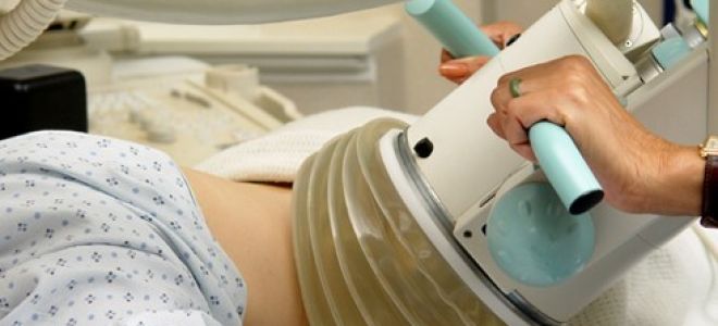 Литотрипсия дистанционная камней в почках: реабилитация и эффективность