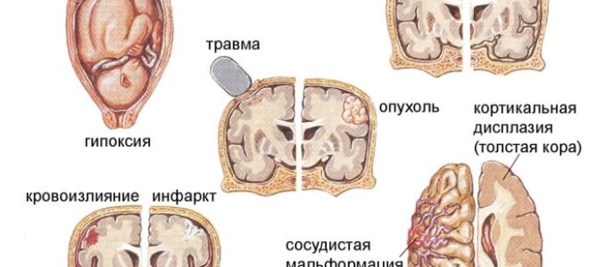 Ципролет при цистите: инструкция к применению, отзывы и аналоги