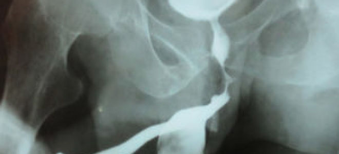 Ретроградная и микционная уретрография у мужчин: что это