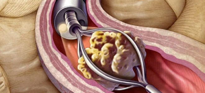 Каликоэктазия почек: признаки, диагностика, лечение и профилактика