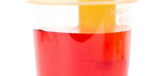 Рак мочевого пузыря у женщин: причины, первые признаки, лечение