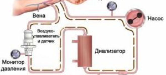 Применение фистулы для гемодиализа: уход и полезные советы