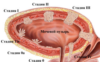 Рак мочевого пузыря у мужчин: стадии, признаки, лечение, выживаемость