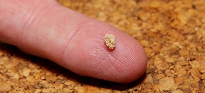 Как выходят камни из почек у женщин и мужчин: симптомы, лечение