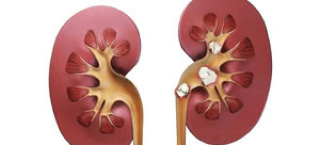 Камни в почках: причины образования, симптомы и лечение
