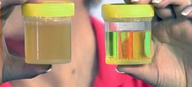 Почему мутная моча у ребенка: норма и причины изменения цвета