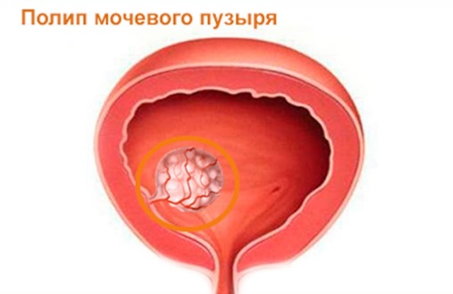 Полипы в мочевом пузыре у женщин: симптомы и лечение заболевания