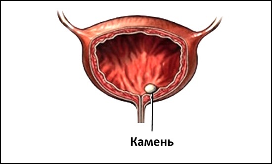 Цистоскопия мочевого пузыря у женщин, мужчин и детей - показания к обследованию, подготовка, отзывы