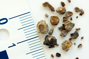 Виды камней в почках: фото, описание и методы диагностики