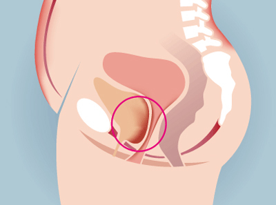 Опущение мочевого пузыря у женщин : что это такое, симптомы, лечение