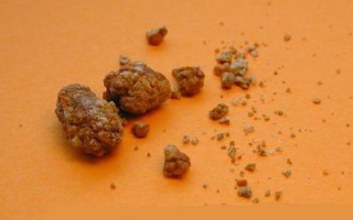 Уратные камни в почках и их растворение: диета как лечение