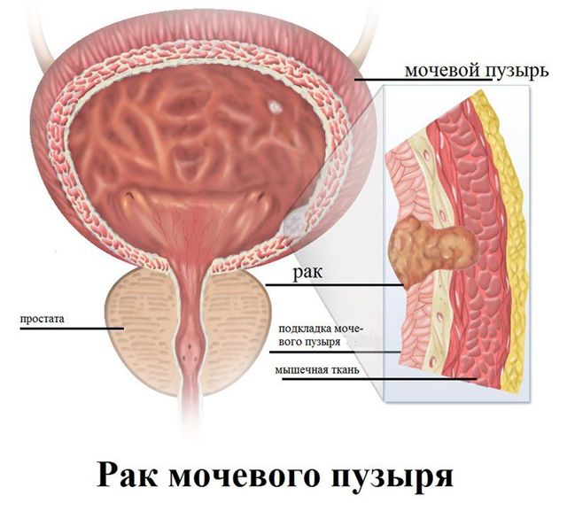 Рак мочевого пузыря у мужчин: стадии, признаки, лечение, выживаемость