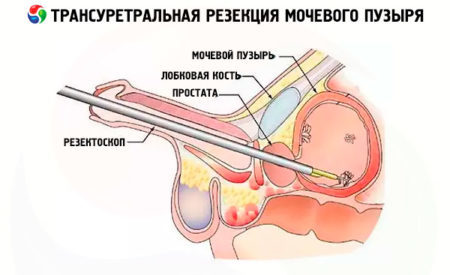 Склероз шейки мочевого пузыря у мужчин: код по МКБ-10, лечение