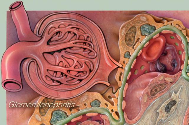 Гломерулонефрит: патогенез, симптомы, диагностика и лечение