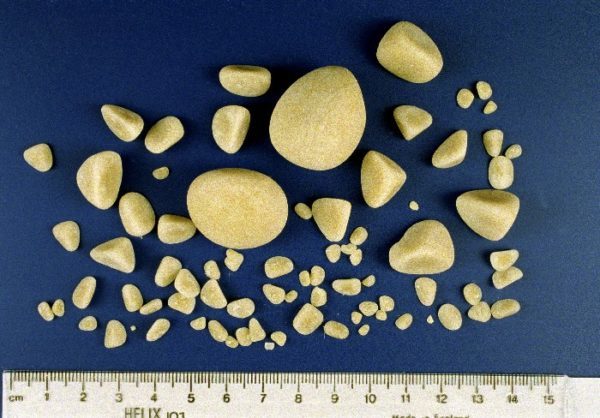 Виды камней в почках: фото, описание и методы диагностики