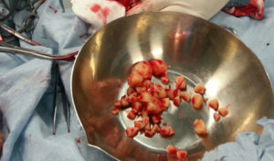 Удаление камней из мочевого пузыря у мужчин (цистолитотомия): ход операции