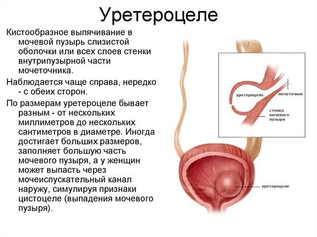 Уретероцеле мочевого пузыря: признаки, лечение и профилактика