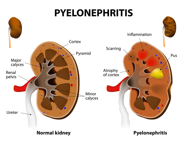 Перинефрит почек: причины, симптомы, диагностика и лечение