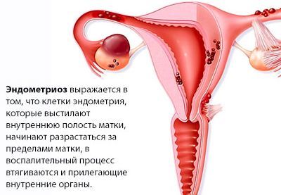 Боли в паху у женщины (слева, справа, в паховой области): причины, симптомы, диагностика