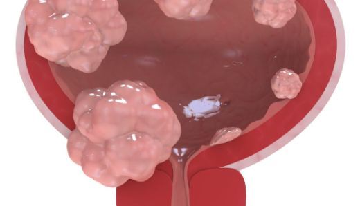 Симптомы кисты мочевого пузыря у мужчин и женщин