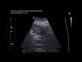 Стент в почке (при беременности): установка, противопоказания, осложнения