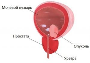 Симптомы кисты мочевого пузыря у мужчин и женщин