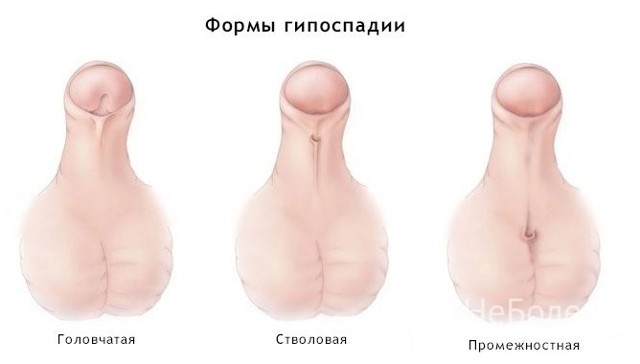 Гипоспадия у новорожденных мальчиков: головчатая, венечная, стволовая, мошоночная