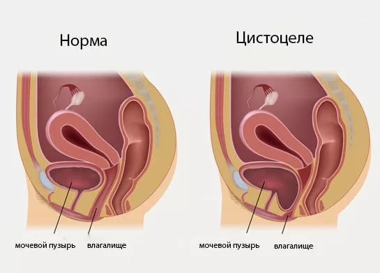Болезни мочевого пузыря: симптомы, лечение у женщин и мужчин