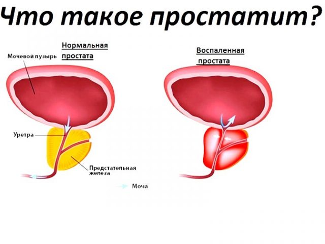 Повышенные эритроциты в моче у женщин, мужчин и детей - причины, норма, лечение