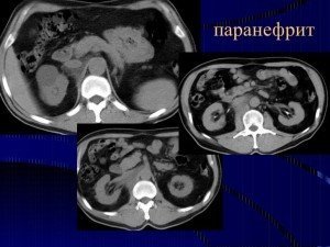 Паранефрит: причины, симптомы, диагностика, лечение и осложнения