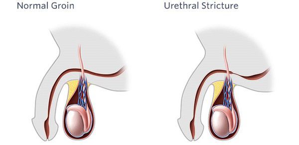 Стриктура уретры у мужчин и женщин: причины, лечение оперативными и народными методами