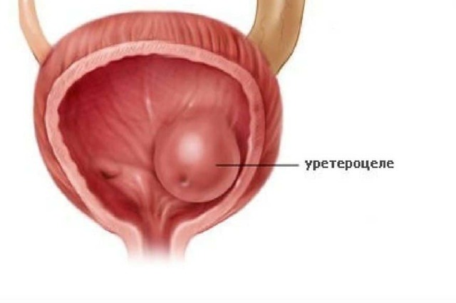 Уретероцеле мочевого пузыря: признаки, лечение и профилактика
