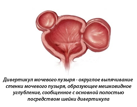 Дивертикул мочевого пузыря: причины, симптомы и лечение
