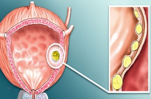 Полипы в мочевом пузыре у мужчин: от чего образуются, симптомы, лечение