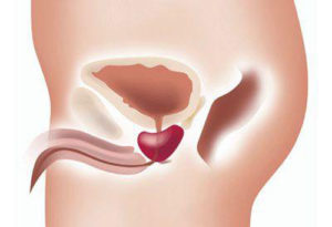 Симптомы рака уретры (мочеиспускательного канала) у мужчин и женщин