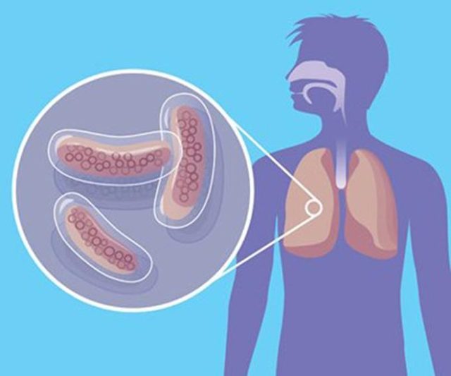 Туберкулез почек: причины, симптомы, диагностика и лечение