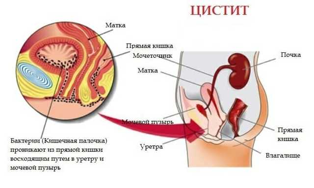 Воспаление мочевого пузыря: причины, симптомы, методы лечения у женщин