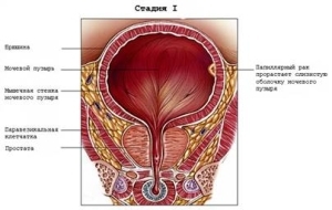 Рак мочевого пузыря: признаки, классификация, стадии, лечение