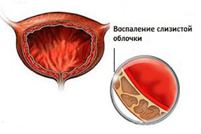 Цистит с кровью: причины, симптомы, лечение препаратами у женщин