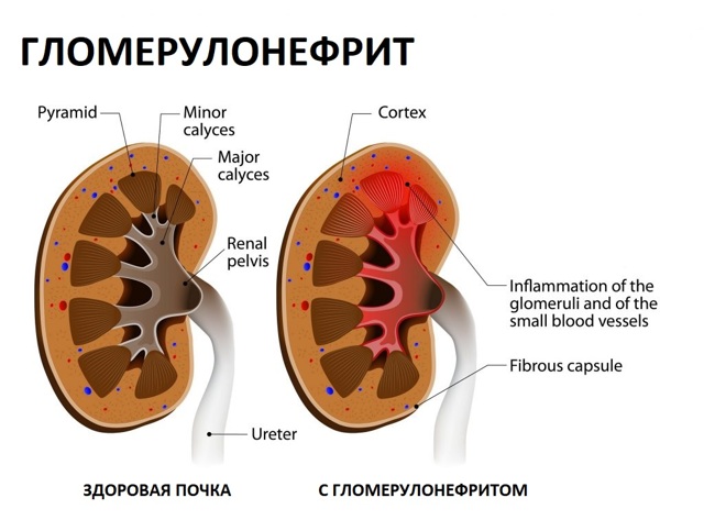 Профилактика гломерулонефрита: правильное питание и образ жизни