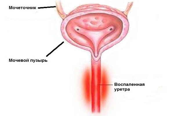 Инфекции мочеполовой системы у женщин и мужчин: симптомы, лечение