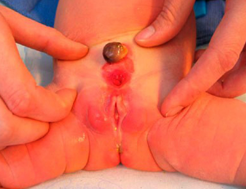 Мегацистис: причины увеличения мочевого пузыря у плода 12 недель
