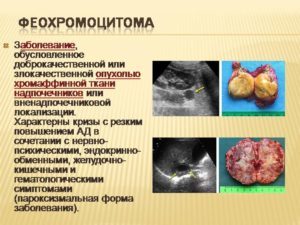 Феохромоцитома надпочечника: симптомы, диагностика и лечение