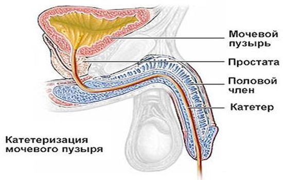 Техника катетеризации мочевого пузыря у мужчин, женщин и детей