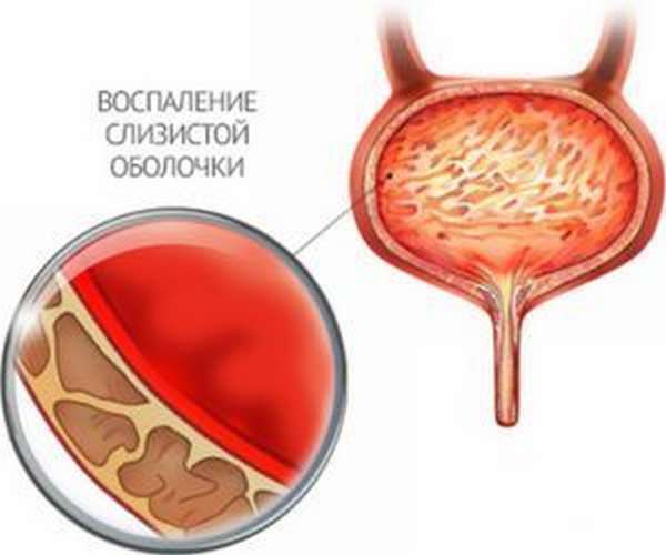 Причины крови и боли при мочеиспускании у женщин