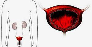 Нейрогенный мочевой пузырь – причины, симптомы, лечение женщин и мужчин