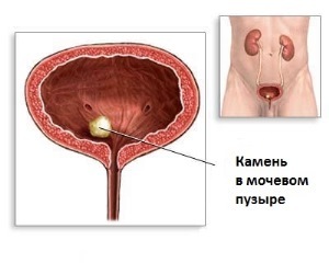 Болит мочевой пузырь - причины у мужчины и женщины, симптомы, чем лечить