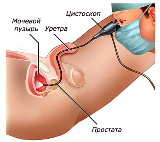 Полипы в мочевом пузыре у мужчин: от чего образуются, симптомы, лечение