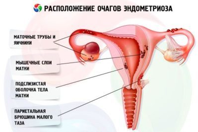 Моча с кровь у женщин (гематурия): причины, симптомы, диагностика, лечение